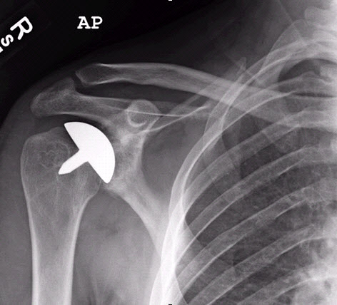 Sogenannter Oberflächenersatz des Humeruskopfes nach Copeland